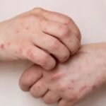OMS alerta para aumento de casos de antraz em humanos e animais