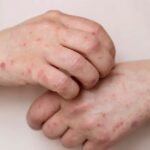 EUA registram 4,5 mil casos de sarampo em 2026 e dobram número de registros de 2025